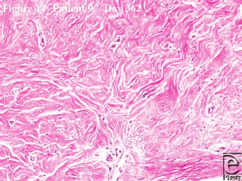 Higher Magnification Histological Appearance Of Scar At Day