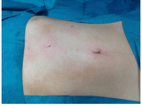 Laparoscopic Inguinal Hernia Repair Scars