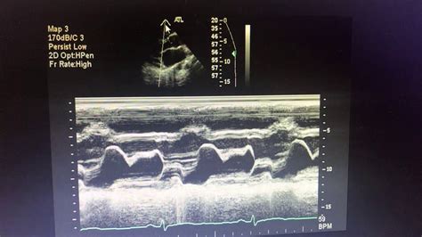 M Mode In Mitral Valve Prolapse Youtube