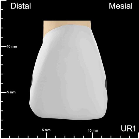 UR1 Mesial and Distal Decay – 10K Teeth