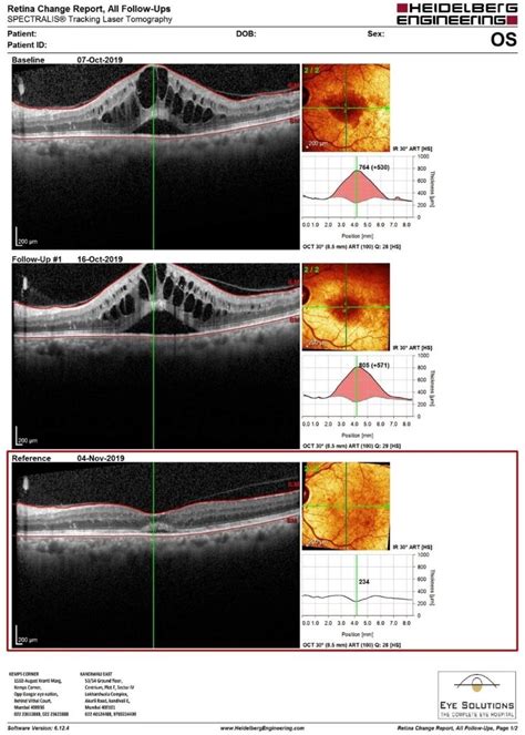 Accentrix eye injection | Anti Vegf | Eye Solutions