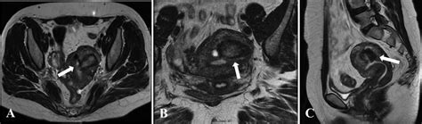 T2 MRI Of Abdomen And Pelvis Demonstrating Approximately 6 Months