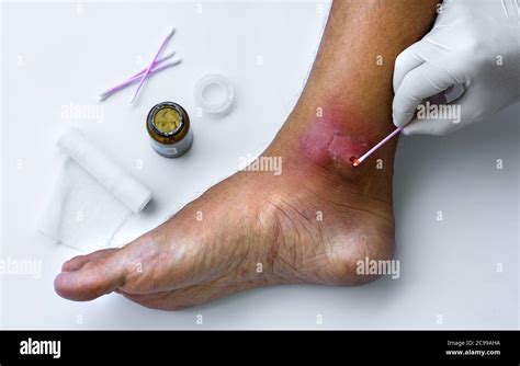 Infected Wound Hi Res Stock Photography And Images Alamy