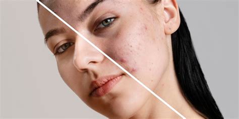 The Ultimate Guide To The Best Acne Treatments In Delhi A Complete Review By Skinlaser Centre