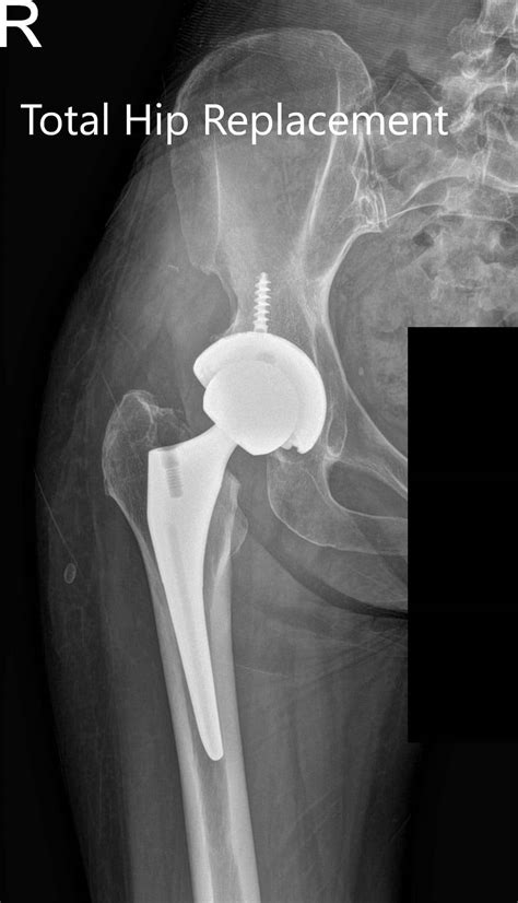 Case Study Bilateral Total Hip Arthritis In Yr Old Male