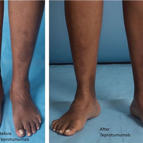 Showing Pretibial Myxedema Before And After Teprotumumab Download Scientific Diagram