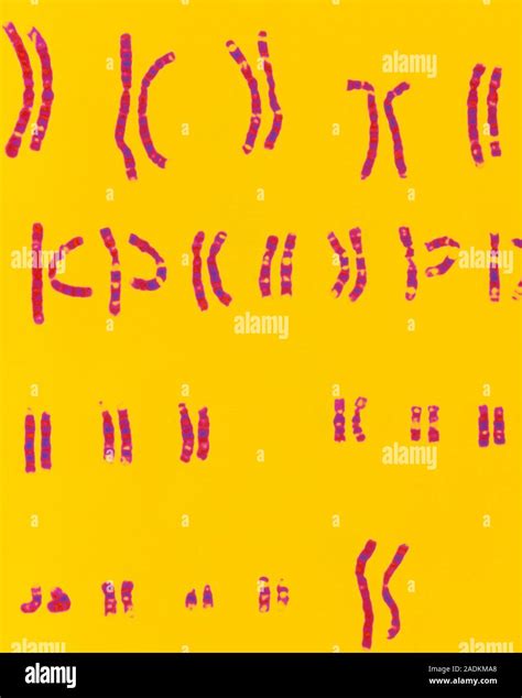 Female chromosomes. Light micrograph of a normal female karyotype, the ...