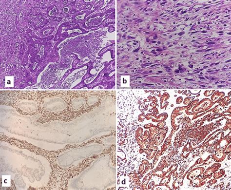 Histopathology Slides × 40 A Atypical Glands Lined By Neoplastic