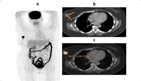 A 55 Year Old Female Patient Arrived With Newly Diagnosed Right Breast Download Scientific