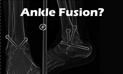 ankle fusion