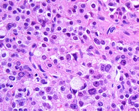 Pathology Outlines Leydig Cell