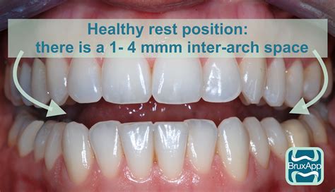 Should Your Teeth Touch When Resting Mewing