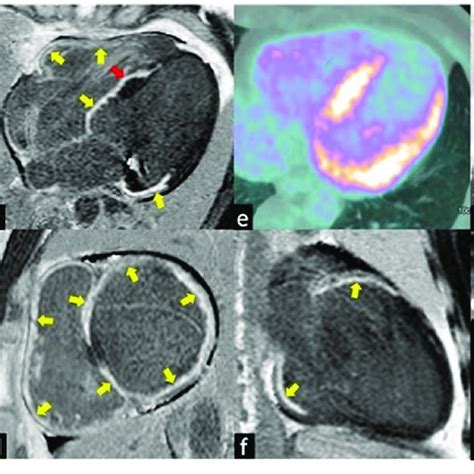 The Images Show A Case Of Typical Cardiac Sarcoidosis Characterized By Download Scientific