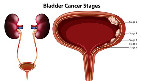 Bladder Cancer Symptoms Treatment And Causes Apex Hospitals