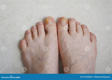 Toenails Affected By Fungal Infection Onychomycosis Stock Photo