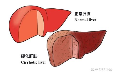 肝硬化，肝是真的硬了吗？ 知乎