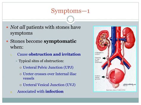 Ppt Urolithiasis Etiology Symptoms And Management Powerpoint