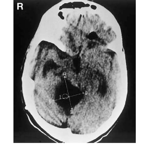 Reported Cases Of Quadrigeminal Arachnoid Cysts In Adults Download Table