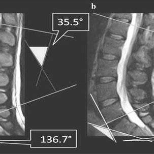 Fast Spin Echo FSE T2 Weighted Magnetic Resonance Images MRI In The