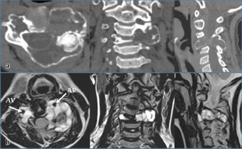 CT And MRI Sections Of An Aneurysmal Bone Cyst Of The C4 Vertebra In A