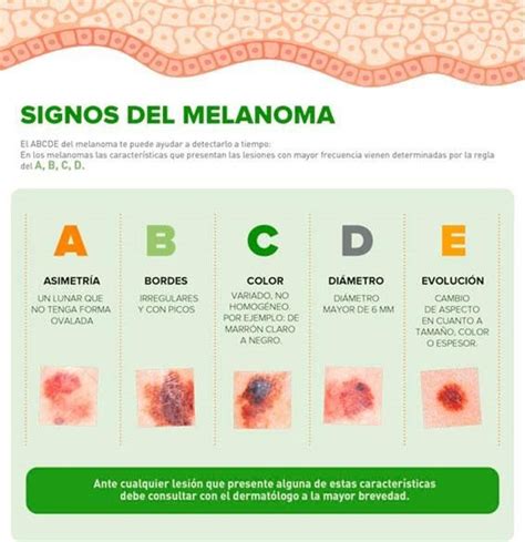 Las Cinco Señales Para Reconocer Un Melanoma En Nuestra Piel