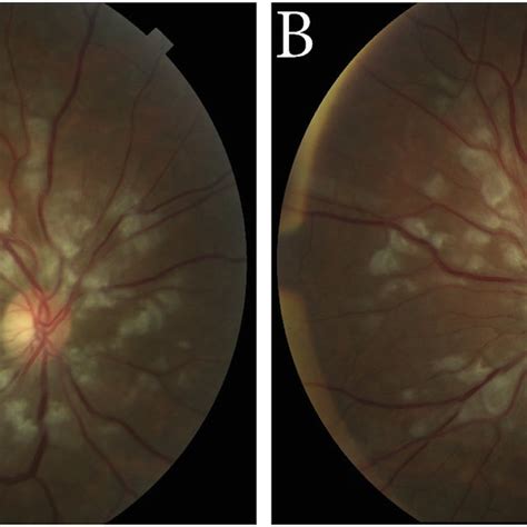 Baseline Color Fundus Photographs Of The Right A And Left B Eyes