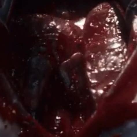 Open Heart Surgery Scene