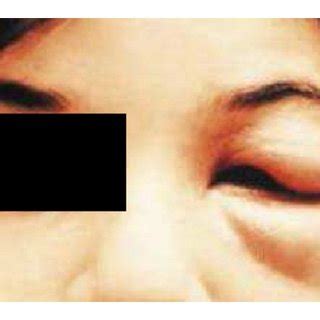 Romana’s sign is characterized by unilateral palpebral edema ...