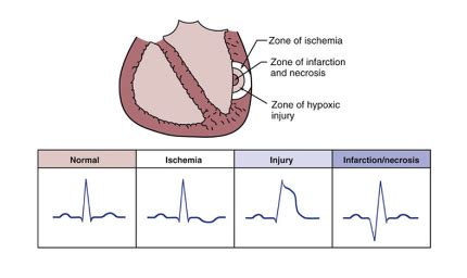 Ischemia and Infarction Flashcards | Quizlet