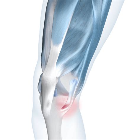 pes anserine bursitis bauerfeind