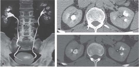 Nephrocalcinosis And Nephrolithiasis Radiology Key