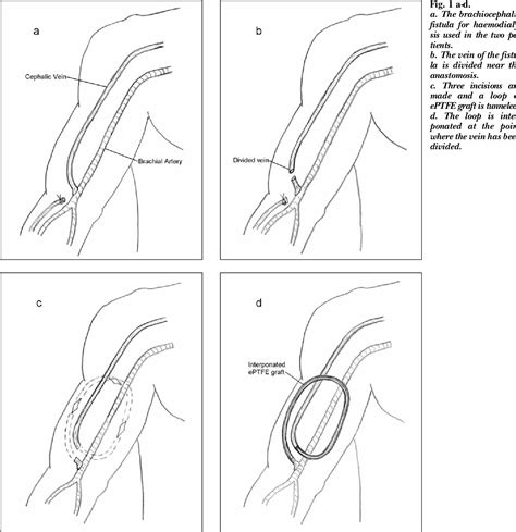 Figure 1 From Steal Syndrome After Brachiocephalic Fistula For Vascular