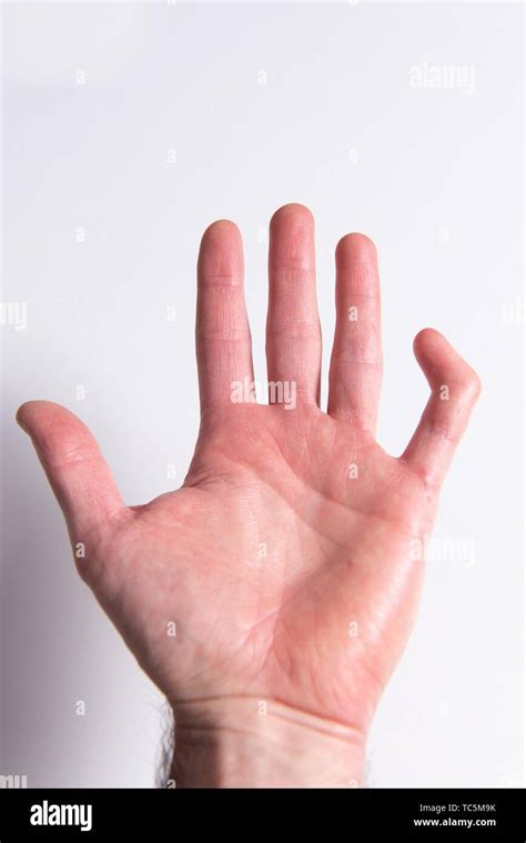 Broken Finger High Resolution Stock Photography and Images - Alamy