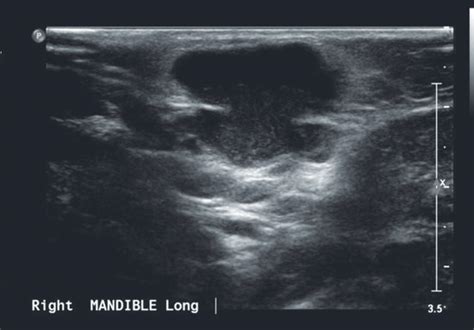 neck masses  children acquired neck masses ento key