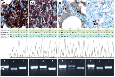 Idh R H Mutation Is A Rare Event In Myeloproliferative Neoplasms As