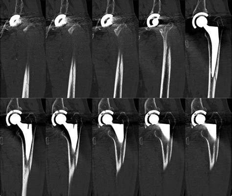 Periprosthetic Fractures Bone Joint