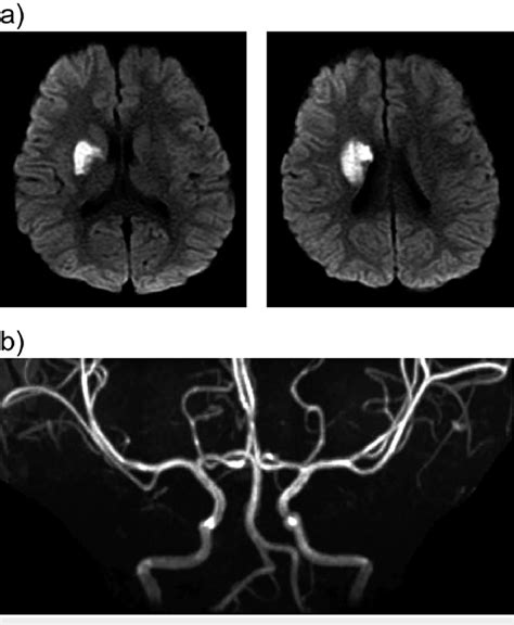 Head Magnetic Resonance Imaging Mri With Diffusionweighted Imaging