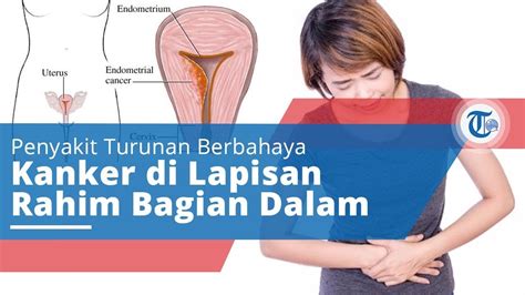 Penyakit Kanker Endometrium Penyakit Kanker Lapisan Dalam Rahim Youtube