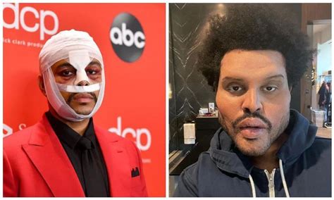 The Weeknd Reveals His Shocking New Plastic Surgery Look Fans Call ‘handsome Squidward The