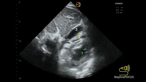 NephroPOCUS On Twitter POCUS Quiz Identify 1 2 And 3 What View