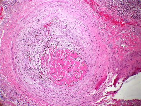 Flickriver Photoset Thromboembolism Thrombosis And Infarction By Pulmonary Pathology