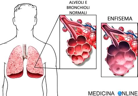 Enfisema Polmonare Cause Sintomi Diagnosi Esami Trattamento