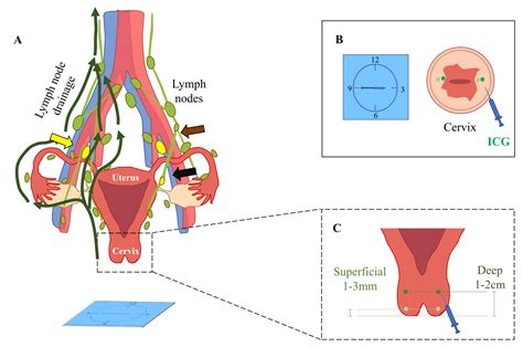 Sentinel Lymph Node Mapping And Biopsy For Endometrial Cancer At Early