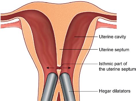 Figure 1 From A Septate Uterus With Double Cervix During Two