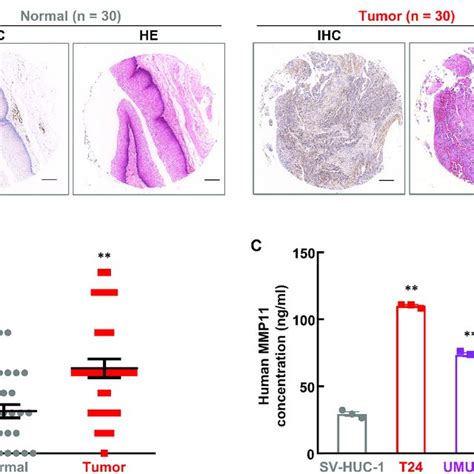 MMP11 Is Upregulated In Bladder Cancer In Vivo And In Vitro A B IHC