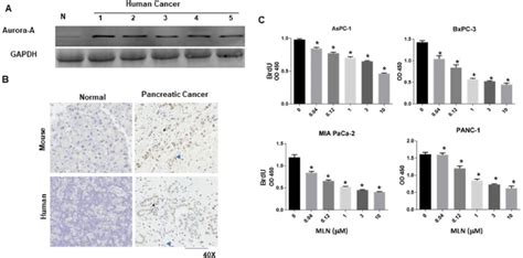 Aurora Kinase A Protein Is Overexpressed In Pancreatic Cancer Tissue