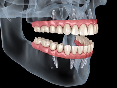 All On 4 Dental Implants Moorehead Dentistry