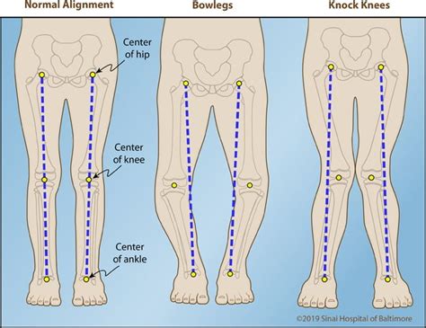 Yoga for Knock Knees - 2 of The Best Yoga Exercises to Correct Your Knock Knees