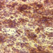 Immunohistochemical Staining For Cd Shows Positive Staining Of