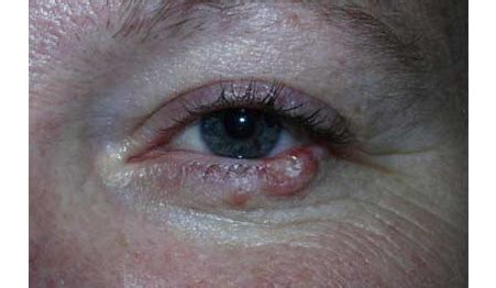 Skin Cancer On Eyelid Symptoms